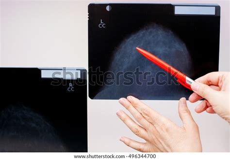 Doctor Points On Roentgenogram Ob Breast Stock Photo 496344700