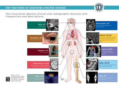 Erdheim Chester Disease Global Alliance