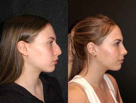 Rhinoplasty Before And After Dr Andrew Jacono Rhinoplasty Nose