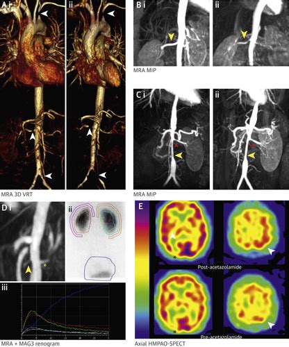 The Impact Of Integrated Noninvasive Imaging In The Management Of