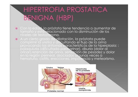 Hipertrofia Benigna De Pr Stata Hpb Por Mercedes Carandini Ppt