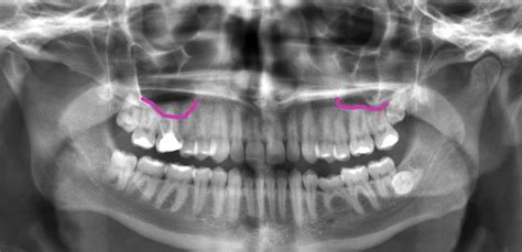 Tooth Pain And Sinuses Can A Sinus Infection Cause A Toothache Oral