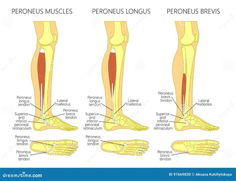 Peroneal Tendon Injuries_Rupture Of The Peroneus Longus Tendon Vector Illustration ...