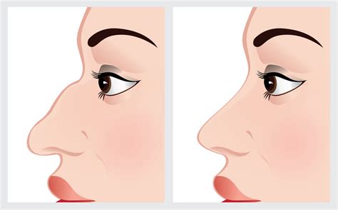 Steps to a Quick and Easy Botox Procedure - Popular RSS Feeds