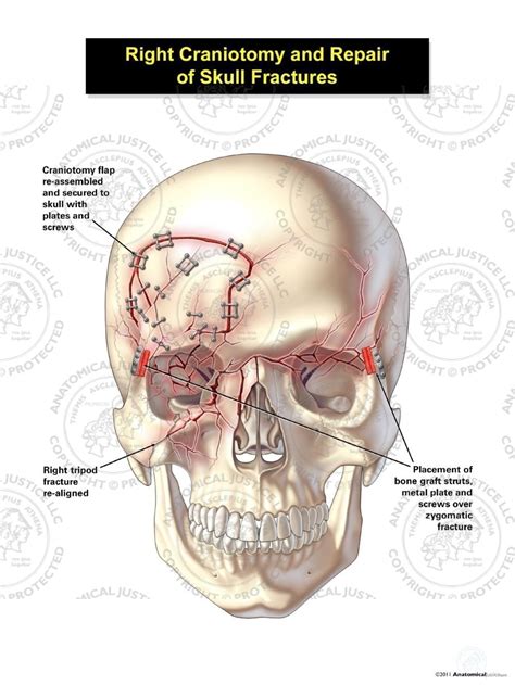 Right Craniotomy And Repair Of Skull Fractures