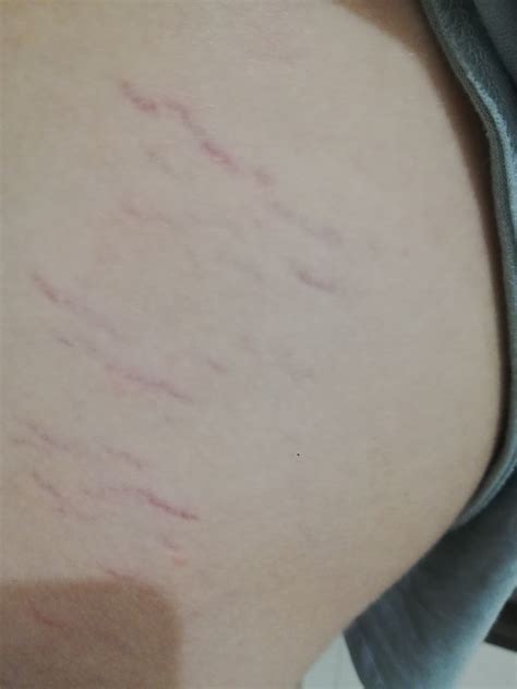 Растяжки на коже у ребёнка? - Вопрос педиатру - 03 Онлайн