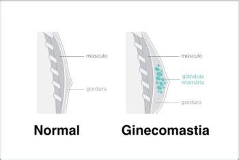 O Que Causa Ginecomastia - Ginecomastia: o que é, causas e tratamento - Tua Saúde - Viva Com ...