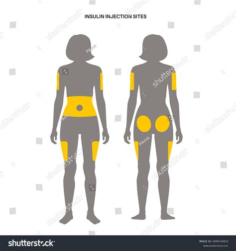 Diabetes Treatment Insulin Injection Sites On Stock Vector (Royalty Free) 2099129410 | Shutterstock