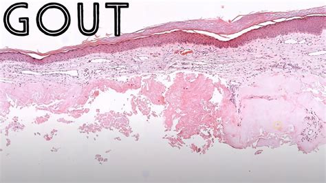 Gout Under The Microscope Gouty Tophus Uric Acid Pathology Dermpath