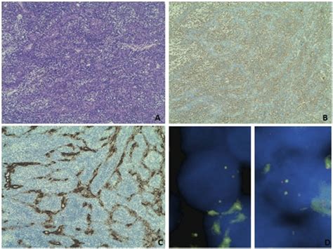 A Biphasic Synovial Sarcoma Showing Epithelial Structures Surrounded