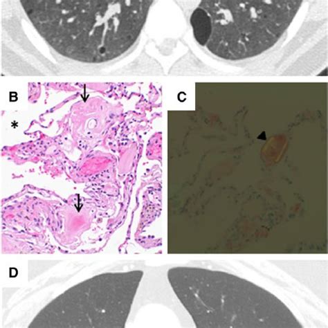 Computed Tomography CT And Histopathologic Images Of Diffuse Cystic