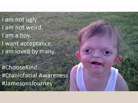 Mom Defends Son With Pfeiffer Syndrome Against Offensive Internet Meme