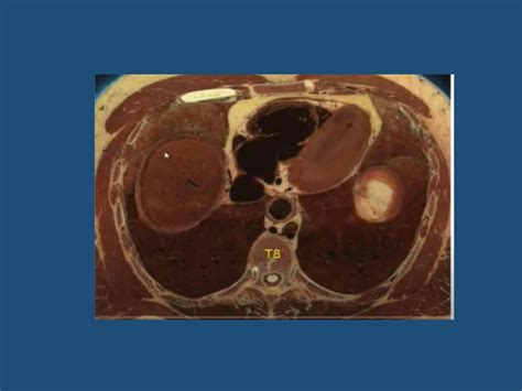 Solution Cross Sectional Anatomy Of The Abdomen Studypool