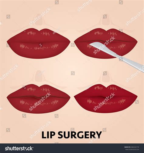 Lip Surgery Before After Vector Illustration Stock Vector (Royalty Free