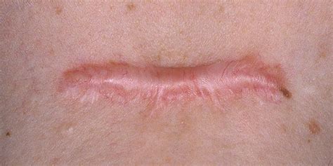 Scars Dr Kate Kelly The Ottawa Clinic