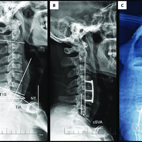 Cervical Curve C2 7 Cobb Angle At Different Time Points Download