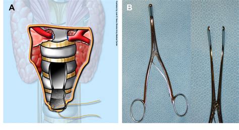 figure   surgical tracheotomy semantic scholar