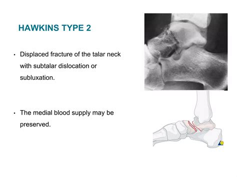 Talus fracture treatment algorithm | PPTX