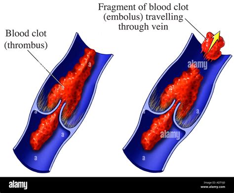 Trombo Venoso Fotos E Imágenes De Stock Alamy