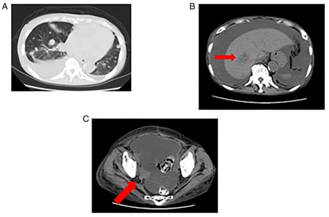 Recurrent Malignant Melanoma Of The Uterine Cervix Treated With Anti‑pd‑1 Antibodies And Anti