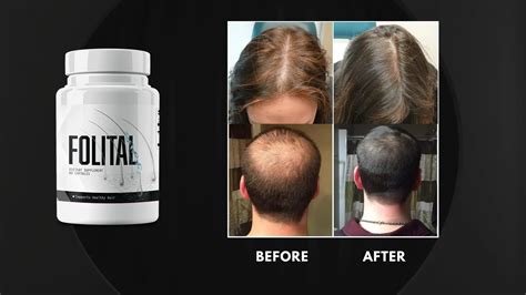 Folital Reviews Does This Hair Health Supplement Live Up To The Hype