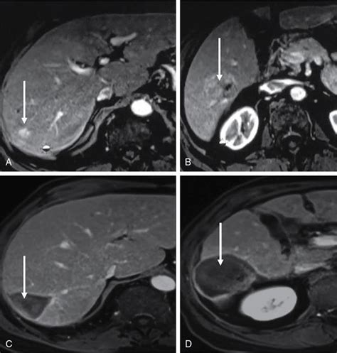 Imaging Guided Ablation Radiology Key
