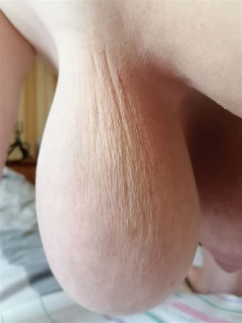 Only Tits Stretch Marks R StretchMarksTits