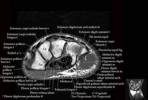 Mri Anatomy Of Wrist