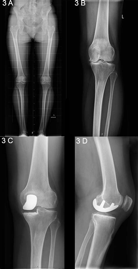 A Long Standing X Ray Showing Unicompartmental Medial Knee