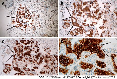 The Immunohistochemistry Showed That The Lesion Was Positive For