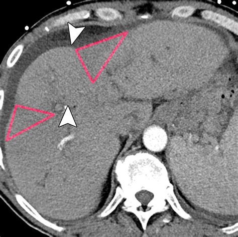 Imaging Features Of Primary Sclerosing Cholangitis From Diagnosis To Liver Transplant Follow Up