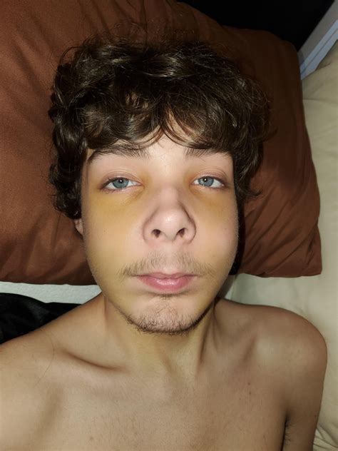 My 15 yr old son, had a 3 piece upper jaw for an open bite with some