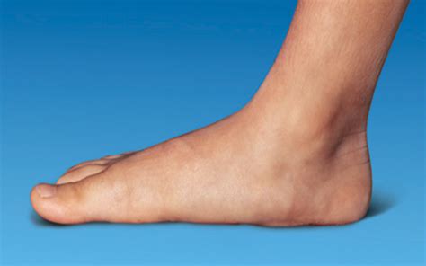 Pied Plat Valgus Chez Lenfant Causes Signes Et Traitement