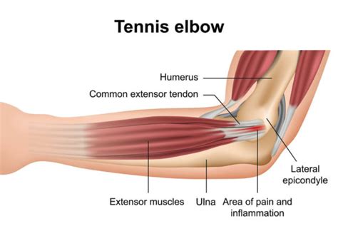 Maori Szobal Ny Puska Tennis Elbow Ultrasound Gy Gy T T R Tt Zemanyag