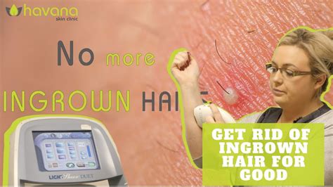 Laser Hair Removal Ingrown Hairs How To Get Rid Of Ingrown Hair Youtube