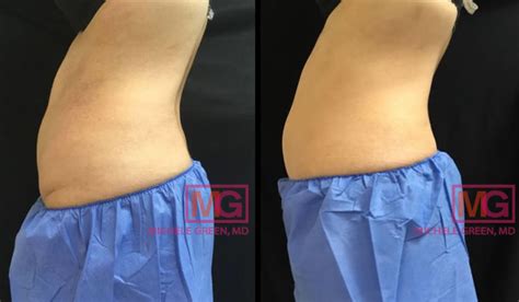 thermage    skin tightening patient photo