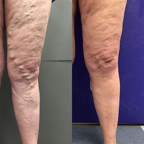 Choosing Your Vein Treatment Veins Specialists Of The Carolinas