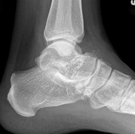 Synovial Chondromatosis | The Bone School