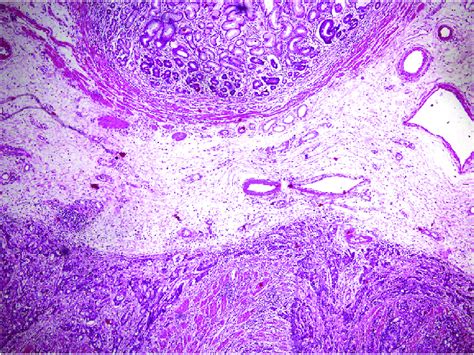 Histopathology Hematoxylin And Eosin Staining Showing Proliferative