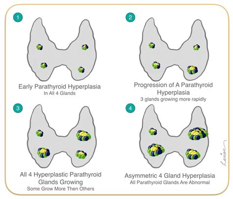 Parathyroid Gland Hyperplasia