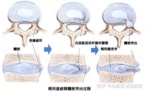 腰椎间盘突出患者的运动禁忌是什么？ 知乎