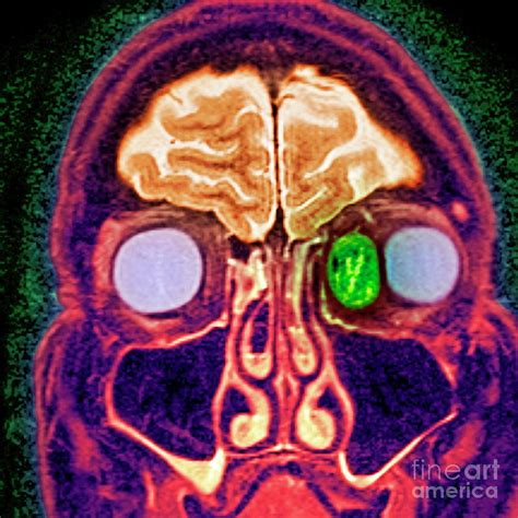 Secondary Cancer Photograph By Simon Fraser Newcastle Hospitals Nhs Trustscience Photo Library