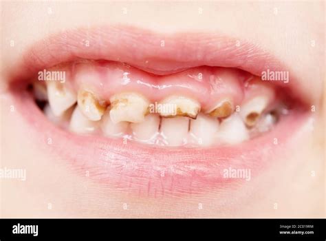 Bad Teeth Hi Res Stock Photography And Images Alamy