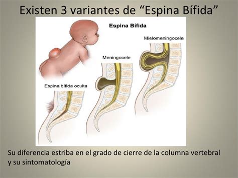 Espina Bifida