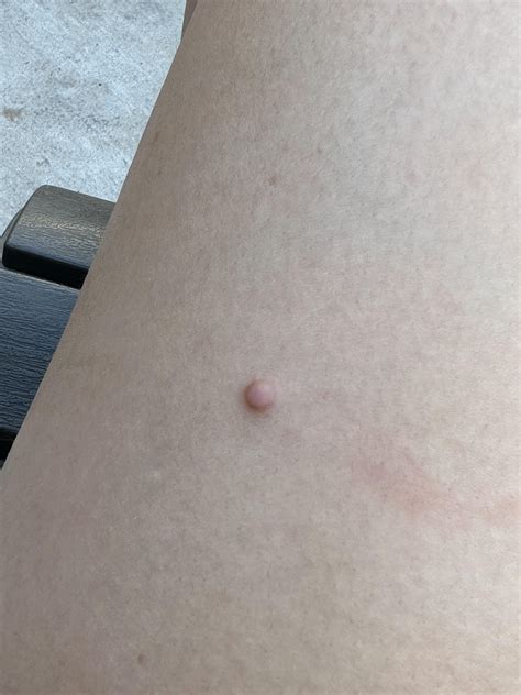 What is this small red bump on my thigh? : r/DermatologyQuestions