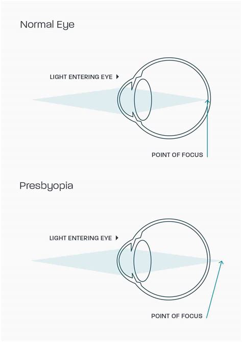 Presbyopia Glasses Direct