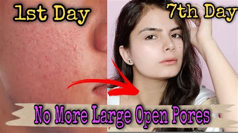 3 Simple Ways To Get Rid From Large Open Pores In 7 Days Permanently 100 Natural And