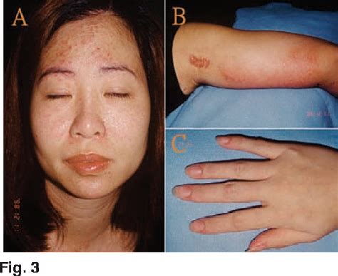 Figure 3 From Panniculitis In Adult Onset Dermatomyositis Report Of Two Cases And Review Of The