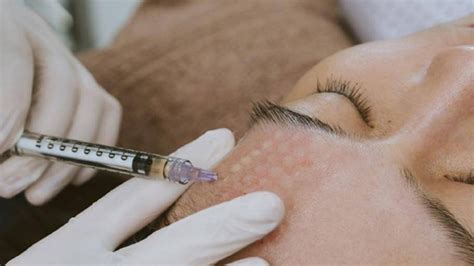 Tiêm Meso Nắm Rõ Những điều Này Chị Em Không Bao Giờ Lo U Hạt Da Ngày