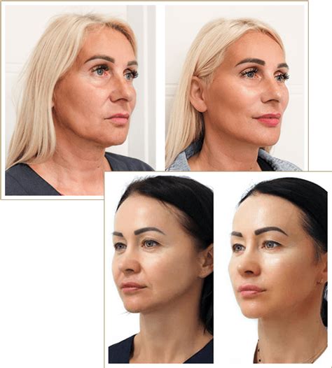 Easylift Lifting twarzy | Nici liftingujące | Warszawa | Klinika ...